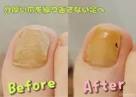 期間限定モニター【分厚い爪!伸びない爪!諦めない!】5月まで12800→8000
