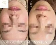 ダウンタイム痛み無し【剥離無し/自信が持てる肌育ハーブ 】🌿ミニモ特別価格《顔用》