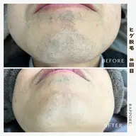 メンズ🤎ヒゲ脱毛(首含む)