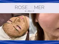 【劇的美肌改革×圧倒的変化】ローズドメーラ剥離ハーブピーリング