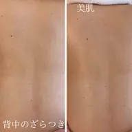 \夏に向けて背中美人に!背中集中ケア/ざらつき・ニキビに◎背中ピーリング+美白パック付き¥5,500
