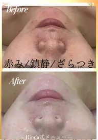 ブライダルエステで挙式前のメンテナンス!気になるドレスのハミ肉上半身の肩甲骨出しと、美肌・肌荒れ鎮静に◎