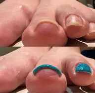 TOEMED巻き爪ケアジェル片足親指5500円。両足親指11000円