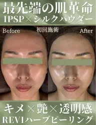【くすみ・色素沈着・赤み悩み】REVI陶肌トリートメント2g(剥けないハーブピーリング)+お任せオプション