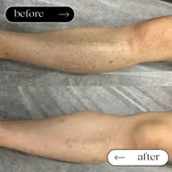 【全身滑らかツルスベ肌✨】毛穴レス!最新・高性能脱毛器!全身脱毛(VIO無し)