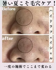 【いちご鼻改善】徹底毛穴洗浄＋毛穴エクストラクション　エイジングケア　艶肌コース
