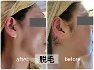 全身脱毛