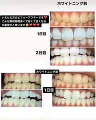 ホワイトニング&耳ツボ🤍🪽 【有名モデル様ご来店】💕"(🉐なsetメニュー)