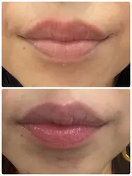 メラニンケア🩷モモトーン🍑momotone🩷目指せピンクの唇！黒ずみをあなた本来の色へ💋最新次世代メラニンケア！