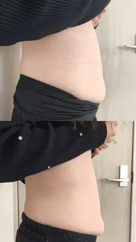 【新規様50%OFF🔥】「着たい服」を諦めない。大人のための部分彫刻キャビテーション 45分（1​〜​2部位）