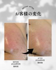 ニキビ、赤み、日焼けに♪最強お肌の鎮静ケア！！炎症は放置すると老化につながるので、早めのケアが必須！！紫外線リセットにも