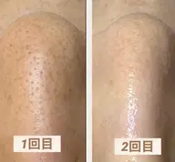【毛穴エクストラクション】鼻のみ　施術箇所の写真掲載可能な方限定￥7000