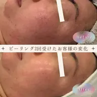 【初回鎮静ジェル付き!】肌質改善ハーブピーリング➕デコルテマッサージ🪸2回回数券‼️1回分が半額✨