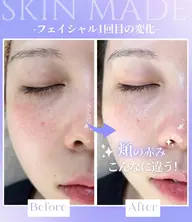 【原因別ニキビケア】繰り返しにくいなめらかな素肌🪽
