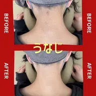 【女性人気】うなじ脱毛