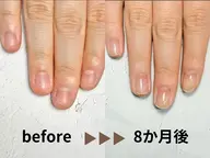 【Jr.ネイリスト自爪育成コース】超特!深爪矯正・自爪育成!3ヶ月で深爪卒業✨一年で縦長美爪になる為のコース★継続必須★