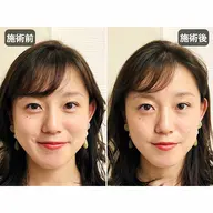 【迷ったらコレ】むくみ・左右差|小顔矯正×EMS美容鍼 50分