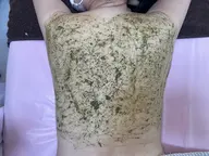 【背中ニキビケア⭐️】剥けないハーブピーリング🌿¥30,800→¥11,000 ❕夏に向けていまから始めましょう♪