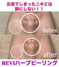 REVIハーブピーリング。ご新規様は¥9900になります。