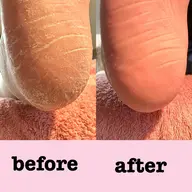 角質ケア付きフットケア