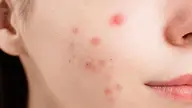 【人気No1🏅】肌細胞修復マシン使用！ニキビ/ニキビ跡/毛穴/肌荒れコース💆‍♀️ 生コラーゲンパック付