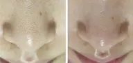 【都度払い】ごっそり落としてさよなら、イチゴ鼻◎毛穴にお悩みの方へ[カウンセリングからお客様に合ったメニューを相談]