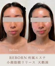 【ハイパーナイフ×筋膜リリース】オールハンド小顔✨