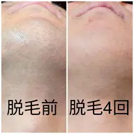 【新規の方】メンズ髭脱毛¥8,000→¥4,000