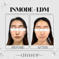 🌿‬期間限定🌿‬小顔Vライン生成◆インモード×LDM水玉リフティング