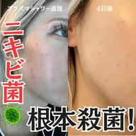 【🚿プラズマシャワー+プラズマリフト+アンプル導入】ニキビを根本殺菌したい、くすみを飛ばしたい方🦠✨
