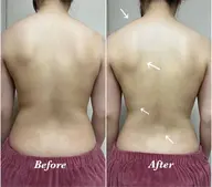 背中全体 👙 REVIハーブピーリング《陶肌トリートメント》 / 痩身効果大!背中荒れ改善・ブライダルにも◎