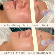 【美容鍼VOSサロンケア黒】約7日間の肌再生‼️ニキビ、ニキビ痕に✨️毛穴/皮脂/ニキビ跡/吹出物/小顔/メンズ