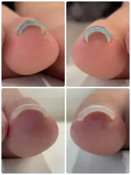 【10名限定❣️】モニター募集✨巻き爪でお悩みの方🦶