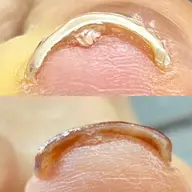 【巻き爪矯正】フット親指2本プラン🍀
