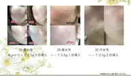 💚剥離あり🌿ハーブピーリング・ソフト🌿ニキビ、ニキビ跡クレーター、毛穴、黒ずみケア