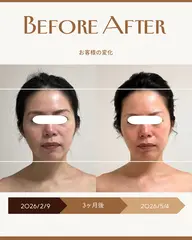 🌿 3ヶ月間(6回来店条件)90分【フェイスラインすっきり小顔ヘッドスパ】
