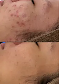 【5名様】卒ニキビしたい方チャンス❣️2万円以上の施術✨SNS写真掲載OKな方！2週​〜​3週間に1度最低4回通える方