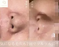 【顔◆最強毛穴ケア】ハーブピーリング×毛穴洗浄×角栓ケア×鎮静
