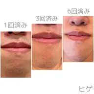 【ミニモ限定🌟メンズ👱‍♂️】　《ヒゲ脱毛》　毎日の自己処理を楽にしませんか？ヒゲ脱毛でカミソリ負けから解放‼️