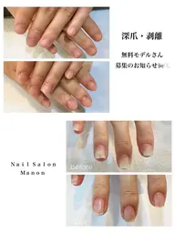 【無料】🌿10/7(水) 13:00​〜​【深爪・剥離】無料モデル募集📢✨