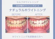 【自然な白さのホワイトニング】歯本来のピカピカの白さを目指していきます😁〈30分照射コース〉