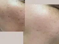 フェイシャルでくすみをケア