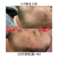 【メンズ】ヒゲ脱毛(目から下全体)