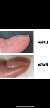 自爪育成 (深爪など) ケア、強化剤使用 クリア仕上げ