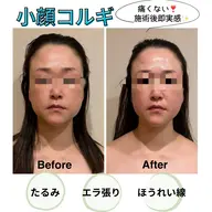【効果即実感✨小顔コルギ❣️】歪み・たるみに❗️痛くない新感覚コルギ🙌