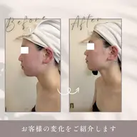 《毛穴黒ずみ・乾燥改善に》小鼻黒ずみ吸引×炭酸毛穴洗浄×小顔コルギ60分