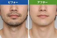 毎朝が楽になる✨️ヒゲ脱毛🪒