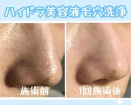美容液で洗浄するハイドラ毛穴洗浄✨頭皮洗浄セット!いちご鼻や頭皮の匂いにお悩みの方お試しください!