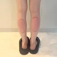 脂肪痩身〈ふくらはぎ〉初回体験2カップ