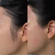 【全顔】おでこ・もみあげ・口周り・頬フェイシャルワックス脱毛🫧シェーバーでは取れない2mm以下の毛を根こそぎ取ります✨